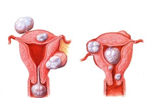 Simptome, semne și tratamentul fibrom uterin