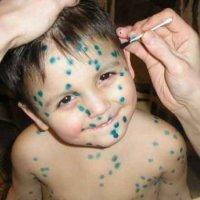 Copilul are varicelă ce să facă un tratament rapid al varicela