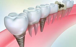 Instalarea implanturi dentare pro și contra vizualizări Preț (implanturi) Instalarea de implanturi dentare și contra, tipuri, preț