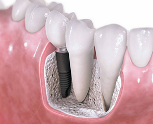 Instalarea de implanturi dentare și contra, tipuri, preț