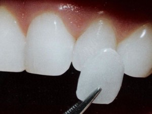Fatetele pe dinti - ceea ce este, prețul, opinii, comentarii, fotografii înainte și după instalare
