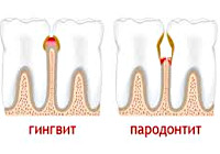 Boala parodontală - cauze, simptome, diagnostic și tratament