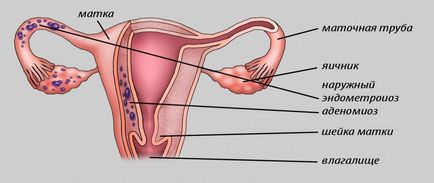 uterin adenomiozei că este limbaj accesibil cu fotografia