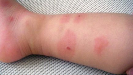 Alergic la mușcăturile de ploșnițe la copii și adulți cum să se uite și cum să trateze