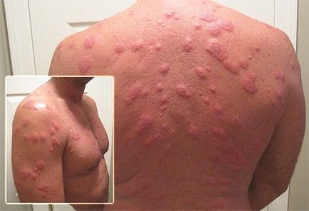 Alergic la mușcăturile de ploșnițe la copii și adulți, simptome și tratament