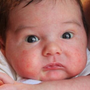 Alergiile in simptomele alergice pentru sugari la copii sub 1 an de diagnostic și nou-născut și