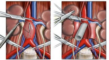 Abdominale simptome anevrism aortic, diagnostic, tratament