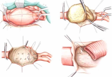 anevrism aortic abdominal sunt introduse la simptome precoce și tratament