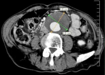 anevrism aortic abdominal sunt introduse la simptome precoce și tratament