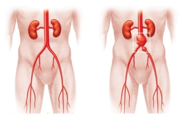 anevrism aortic abdominal sunt introduse la simptome precoce și tratament
