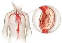 anevrism aortic abdominal sunt introduse la simptome precoce și tratament