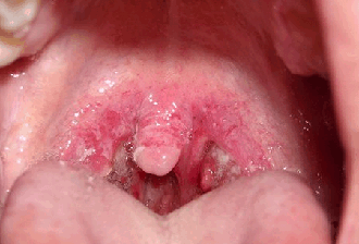 sânge Angina - de ce apare în gât și sputa