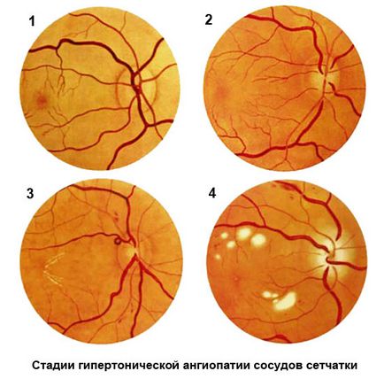 angiopatie retiniana ce este, cauze, simptome și tratament