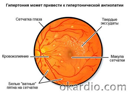 angiopatie retiniana ce este, cauze, simptome și tratament