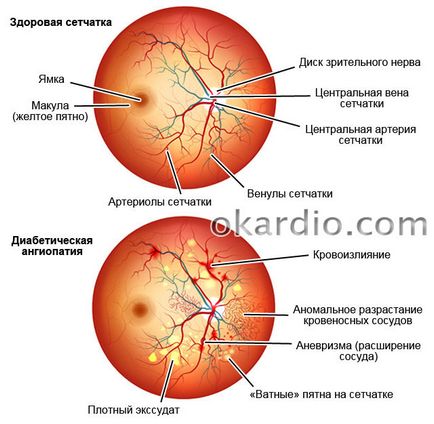 angiopatie retiniana ce este, cauze, simptome și tratament