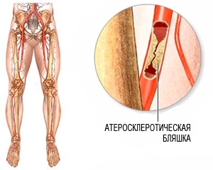 Ateroscleroza a extremităților inferioare - Tratamentul de remedii populare, dieta, gimnastica