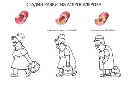 Ateroscleroza a extremităților inferioare - Tratamentul de remedii populare, dieta, gimnastica