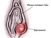 Bartolini - cauze, simptome, diagnostic și tratament