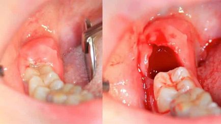 ulcerelor cutanate după extracția dentară care fac