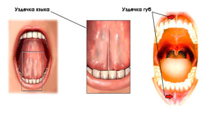 Mă doare limba atunci când înghițire o parte și cum să trateze cauzele bolii
