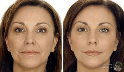 raspunsuri faciale cu botox și posibilele consecințe negative,