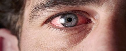 Ce ar trebui să fac în cazul în care ochii inflamat de sudură arsură