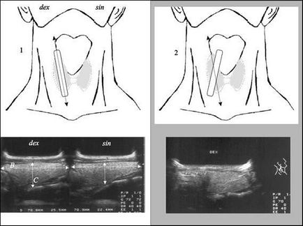 Ce se va tiroidiene cu ultrasunete