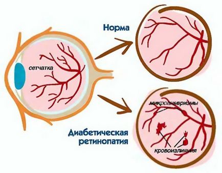Ce este un retiniană cauze angiopatie și simptome, tratamentul și prevenirea patologice