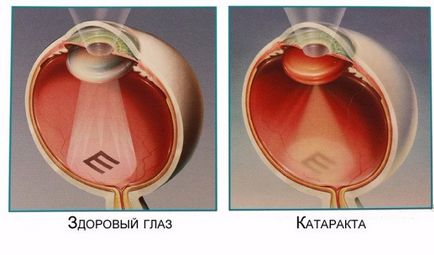 Ce este un retiniană cauze angiopatie și simptome, tratamentul și prevenirea patologice