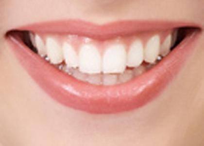 Ce sunt implanturile dentare, contraindicații pentru aceasta