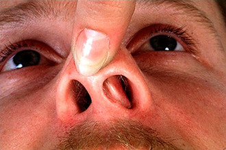Ce este repoziționarea oaselor nazale - cum să îndreptați nas