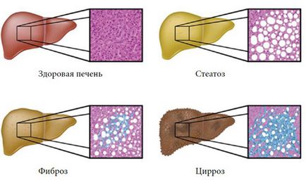 Care sunt simptomele de steatoză hepatică, tratamentul de remedii populare și medicamente