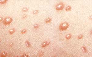 Ce este varicelă și modul în care se manifestă