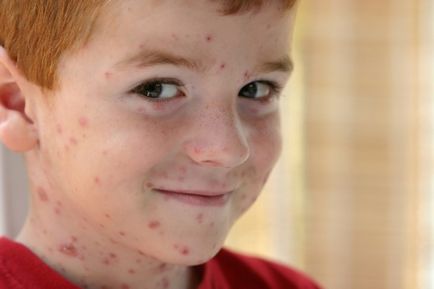 Ce este varicelă și modul în care se manifestă în special varicela