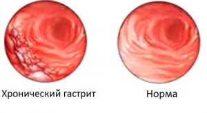 Eficacitatea tratamentului gastritei cu aciditate remedii populare