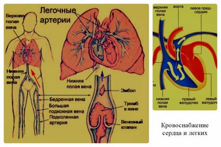 semne embolia, clasificare, diferențele embolia dintr-un cheag de sânge, video