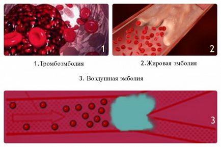 semne embolia, clasificare, diferențele embolia dintr-un cheag de sânge, video