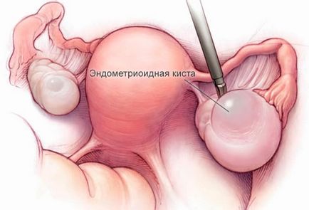 chist ovarian endometrioid - cauzele, tratamente, simptome
