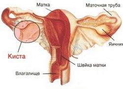 corpus uterele Endometrioza