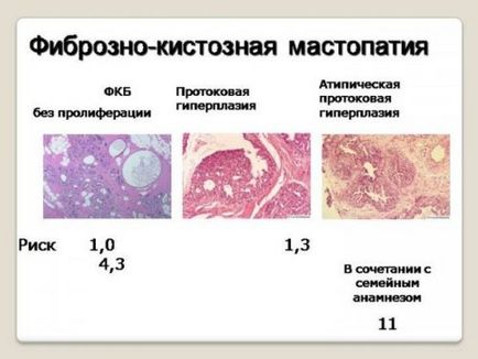 Ehopriznaki boala fibrochistica a sanului