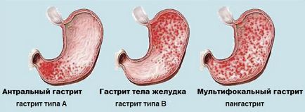 Gastrita cu simptome de aciditate ridicată, tratament, remedii populare, dieta