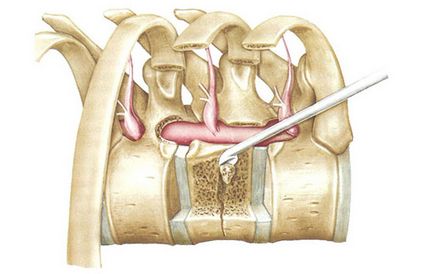 hemangiom a coloanei vertebrale, care este, ceea ce este periculos, tratament