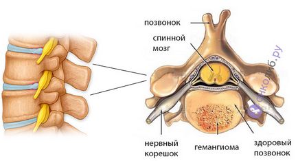 hemangiom a coloanei vertebrale, care este, ceea ce este periculos, tratament