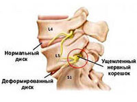 spinale tratament hemangiom, cauze, simptome și semne
