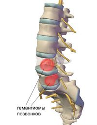 spinale tratament hemangiom, cauze, simptome și semne