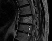 spinal hemangiom - cauze, simptome, diagnostic și tratament