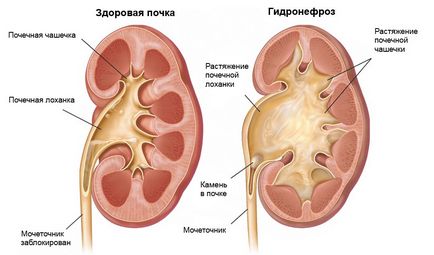 hidronefroza rinichi care este tratată fără o intervenție chirurgicală în timpul sarcinii, simptome, și două căi