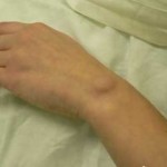 Higroma privind tratamentul mână și o fotografie a tumorii