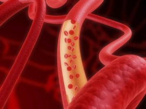 Hipertensiune ce este clasificarea bolii hipertensive