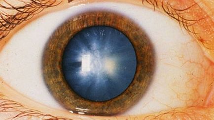 Simptomele de presiune a ochilor și tratament